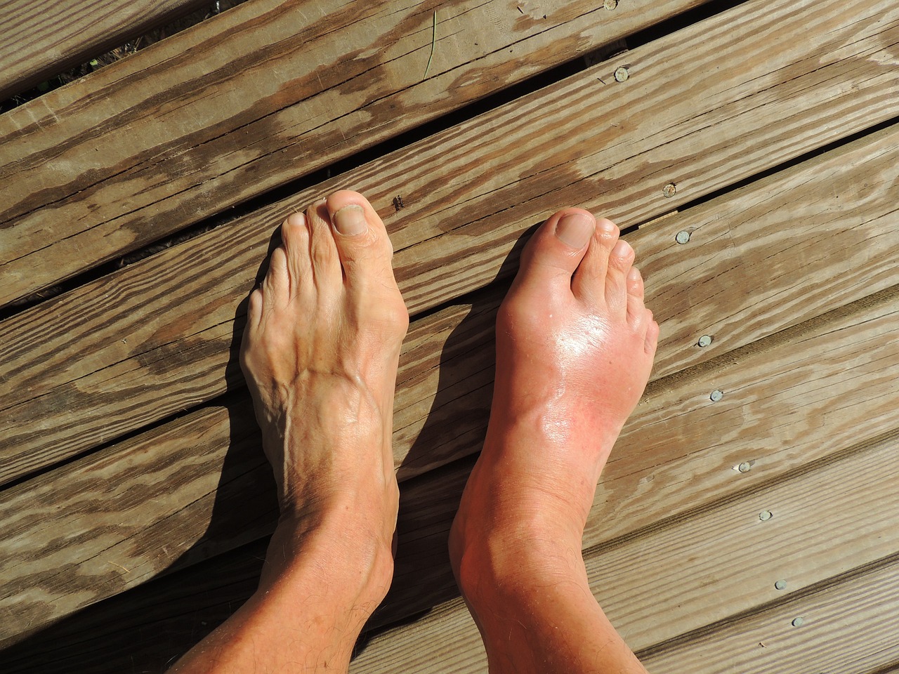feet, gout, pain-174216.jpg